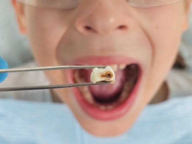 Best Emergency Tooth Extraction in Leon Valley, TX